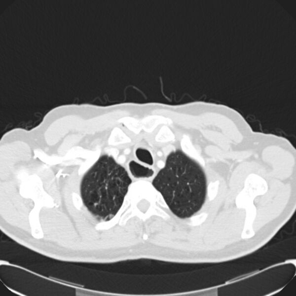 File:Achalasia (Radiopaedia 24937-25206 Axial lung window 3).jpg