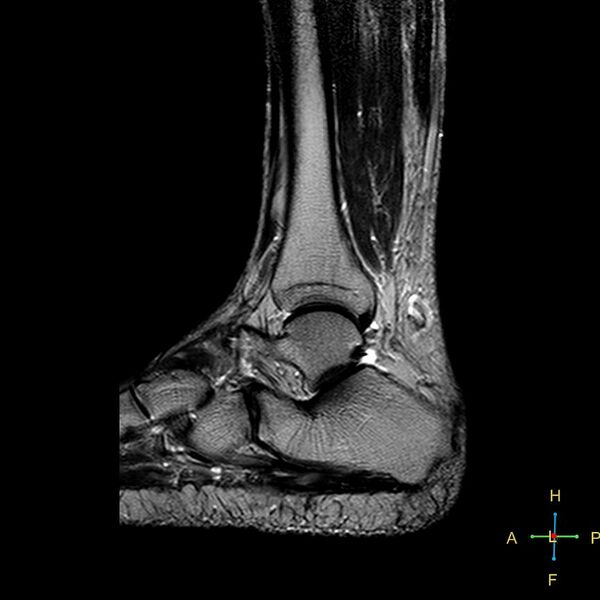 File:Achilles tendon complete tear (Radiopaedia 22834-22854 Sagittal T2 6).jpg