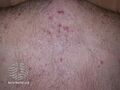 Acne affecting the back images (DermNet NZ acne-acne-back-189).jpg
