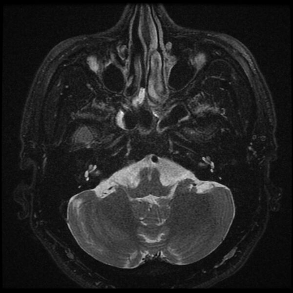 File:Acoustic schwannoma - intracanalicular (Radiopaedia 37247-39024 Axial T2 fat sat 6).jpg