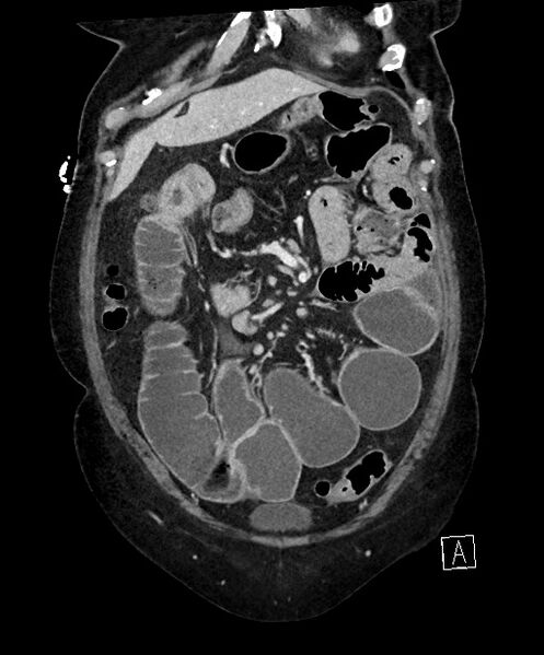 File:Active Crohn disease (Radiopaedia 59394-66750 Coronal C+ portal venous phase 22).jpg