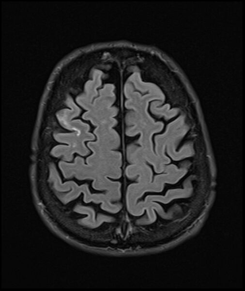 File:Acute P1 occlusion with PCA ischemia penumbra (CT perfusion) (Radiopaedia 72084-82590 Axial FLAIR 31).jpg