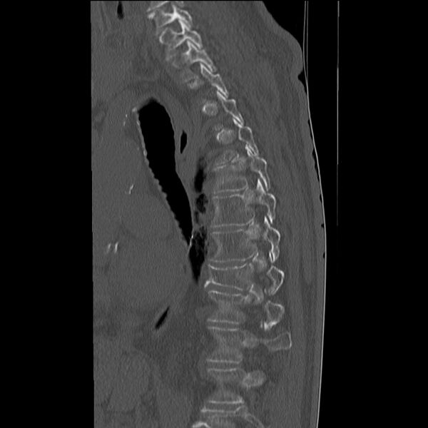 File:Acute and chronic vertebral compression fractures (Radiopaedia 31608-32494 Sagittal bone window 6).jpg