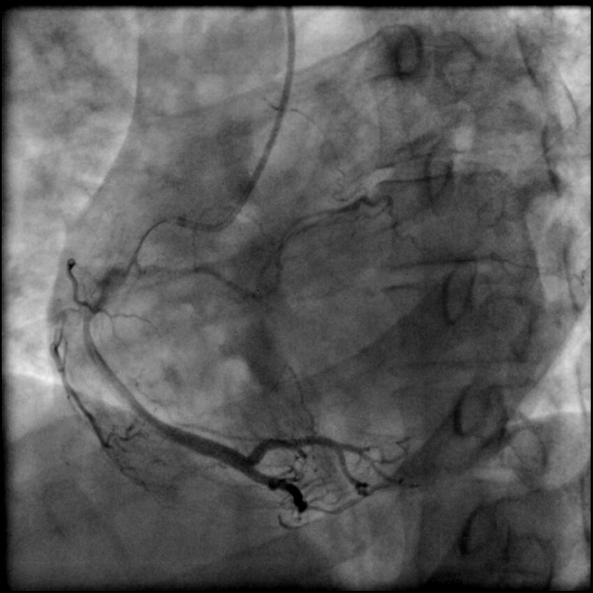 Acute anteroseptal myocardial infarction (Radiopaedia 68409-77946 RAO straight RCA 48).jpg