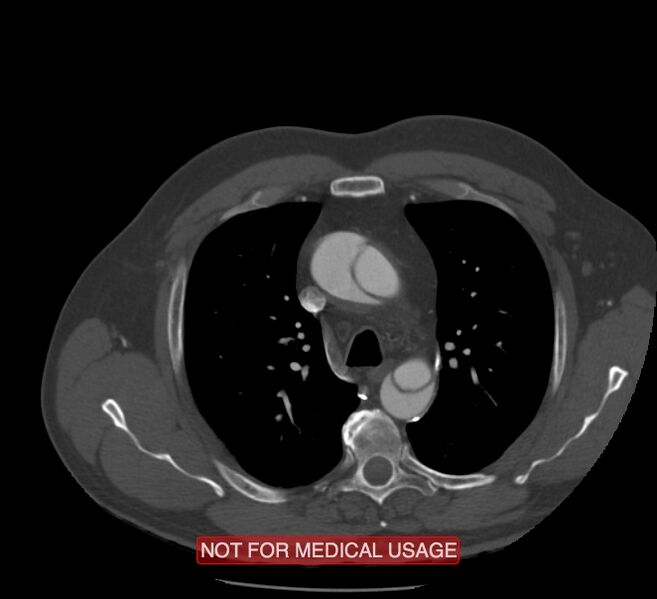 File:Acute aortic dissection - Stanford type A (Radiopaedia 40661-43285 Axial C+ arterial phase 13).jpg