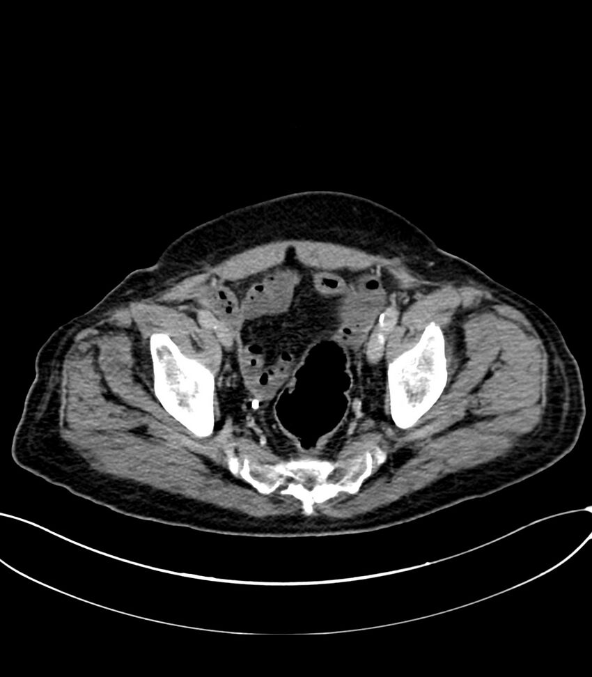 Acute arterial mesenteric ischemia (Radiopaedia 78238-90828 Axial C+ delayed 124).jpg