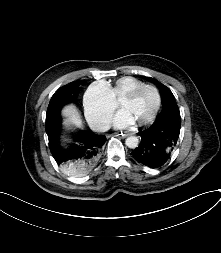 Acute arterial mesenteric ischemia (Radiopaedia 78238-90828 Axial C+ portal venous phase 12).jpg