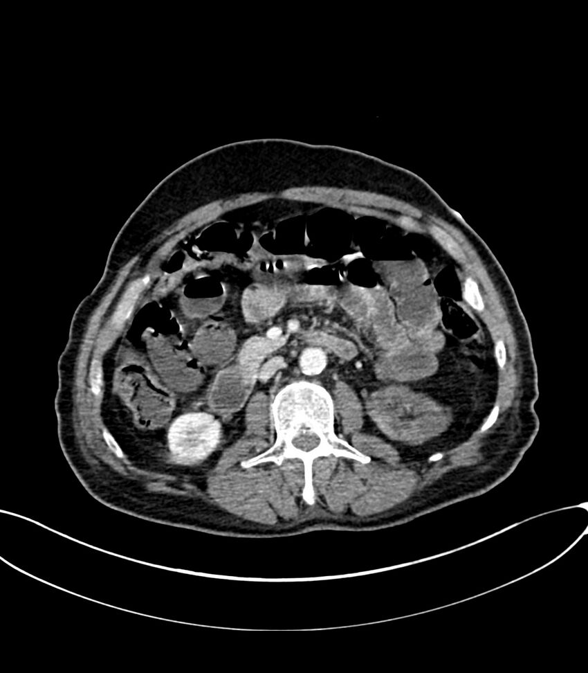 Acute arterial mesenteric ischemia (Radiopaedia 78238-90828 Axial C+ portal venous phase 60).jpg