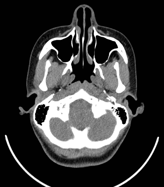 File:Acute bacterial tonsillitis (Radiopaedia 22882-22908 Axial non-contrast 4).png