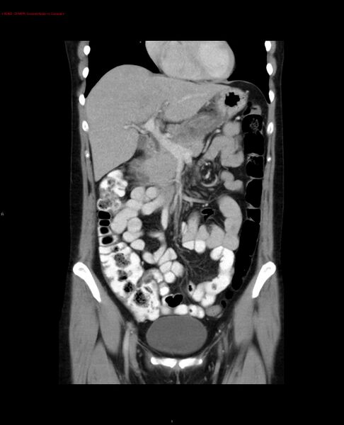 File:Acute gastritis (Radiopaedia 21043-20975 Coronal C+ portal venous phase 18).jpg