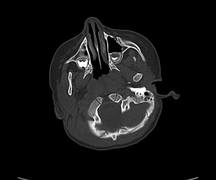File:Acute hemorrhagic contusion (Radiopaedia 63660-72336 Axial bone window 10).jpg