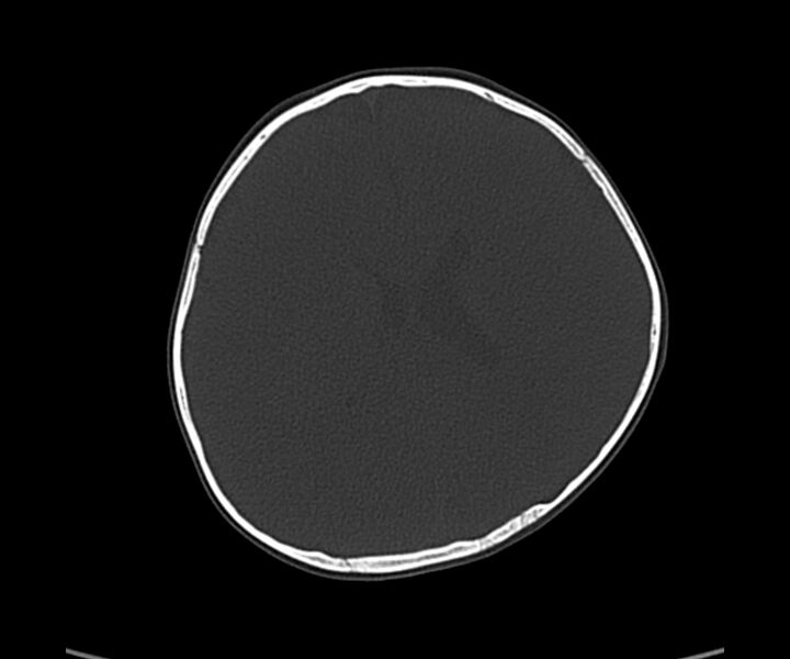 File:Acute hemorrhagic contusion (Radiopaedia 63660-72336 Axial bone window 42).jpg