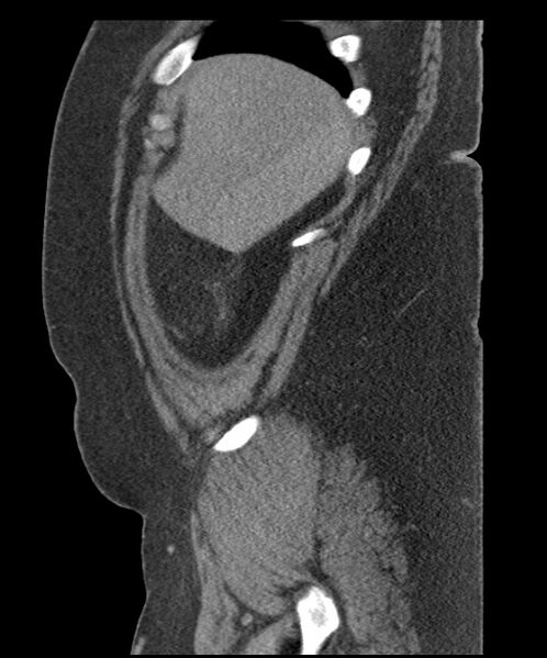 File:Acute mesenteric venous ischemia (Radiopaedia 46041-50383 Sagittal C+ portal venous phase 14).jpg