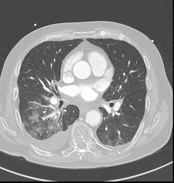 File:Acute myocardial infarction (Radiopaedia 23413-23481 lung window 30).jpg