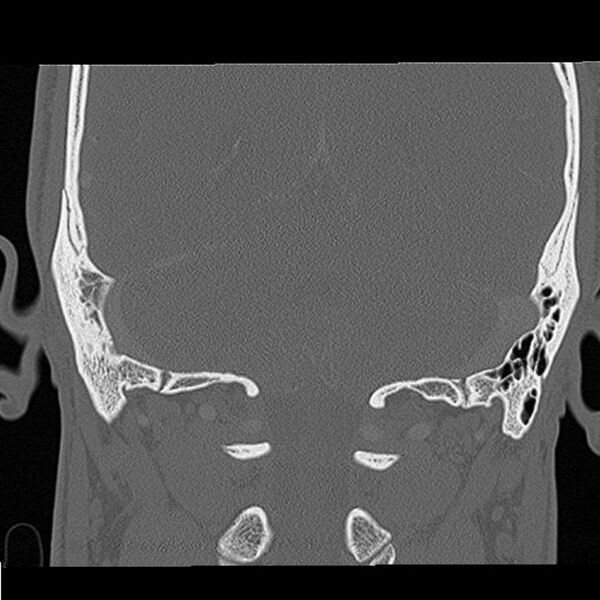 File:Acute otomastoiditis (Radiopaedia 28329-28575 Coronal bone window 1).jpg