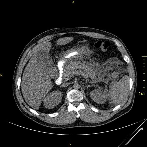 File:Acute pancreatitis (Radiopaedia 23231-23290 Axial oral contrast 39).JPG