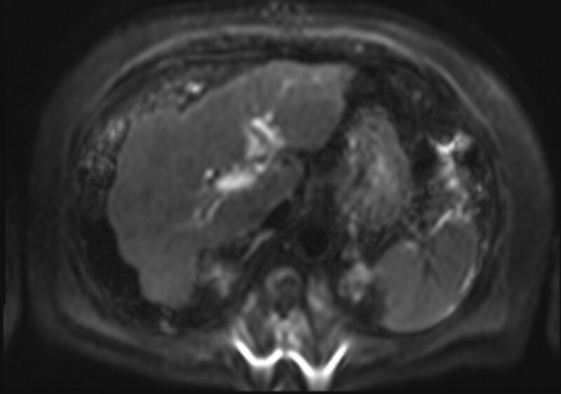 File:Acute portal vein thrombosis (Radiopaedia 73198-83925 Axial DWI 13).jpg