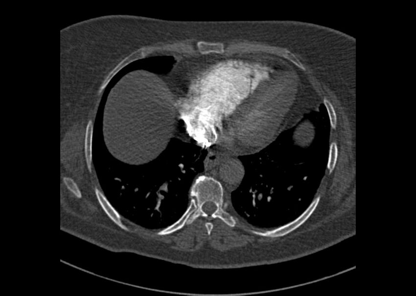 Acute pulmonary embolism (Radiopaedia 29938-30466 Axial C+ CTPA 160).jpg