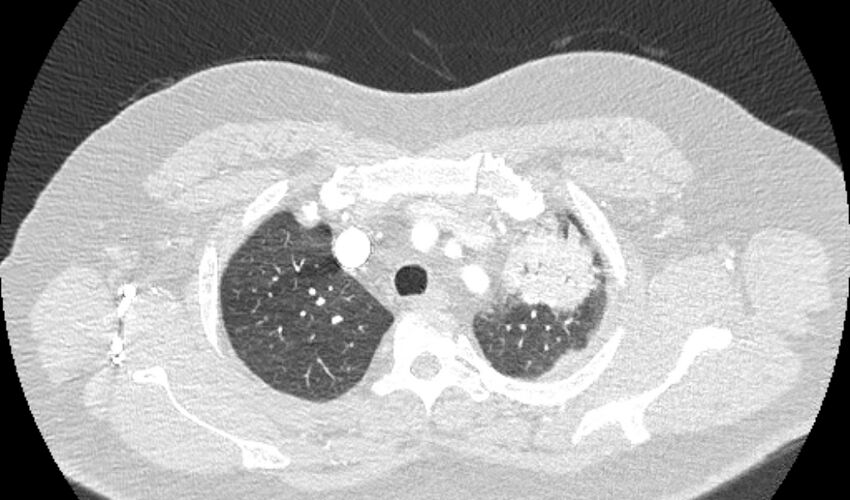 Acute pulmonary embolism with pulmonary infarcts (Radiopaedia 77688-89908 Axial lung window 12).jpg