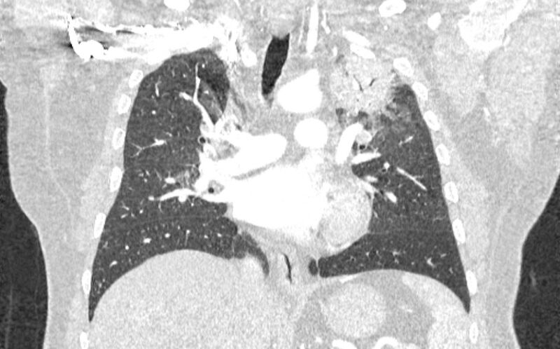 File:Acute pulmonary embolism with pulmonary infarcts (Radiopaedia 77688-89908 Coronal lung window 47).jpg