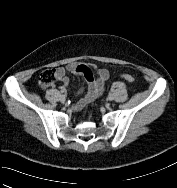 File:Acute pyelonephritis (Radiopaedia 40264-42816 Axial renal excretory phase 27).jpg
