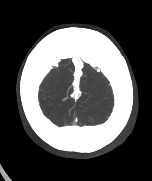 File:Acute right MCA M1 occlusion (Radiopaedia 62268-70454 Axial Phase 1 4).jpg