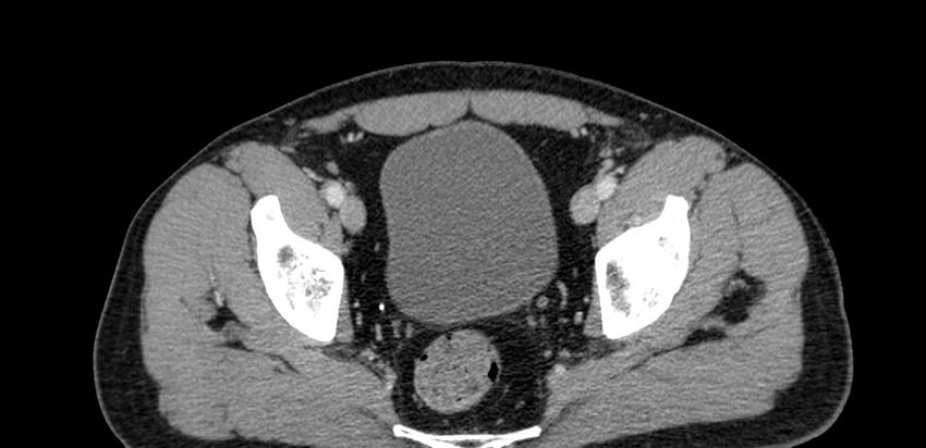 Acute sigmoid colon diverticulitis (Radiopaedia 55507-61976 Axial C+ portal venous phase 105).jpg