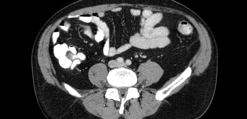 Acute sigmoid colon diverticulitis (Radiopaedia 55507-61976 Axial C+ portal venous phase 49).jpg