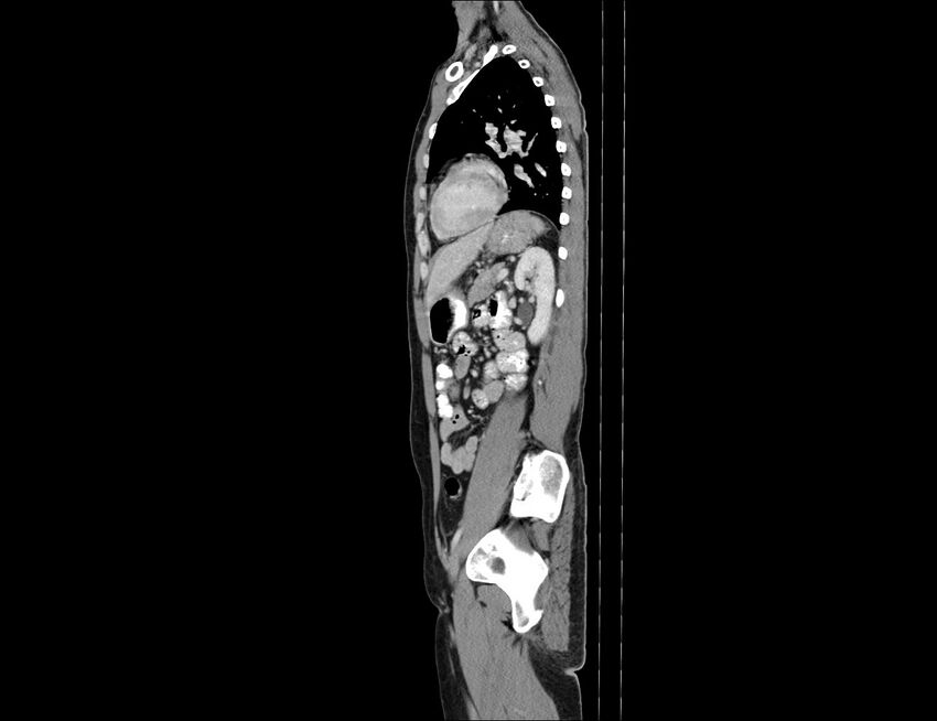 Addison disease (Radiopaedia 49318-54412 Sagittal C+ portal venous phase 23).jpg
