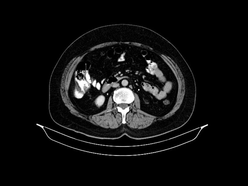 File:Adenocarcinoma of pancreas with hepatic metastasis (Radiopaedia 64332-73122 Axial C+ delayed 51).jpg
