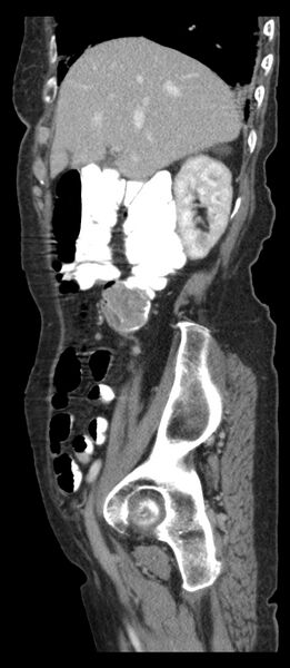 File:Adenocarcinoma of pancreas with hepatic metastasis (Radiopaedia 64332-73122 Axial C+ portal venous phase 37).jpg
