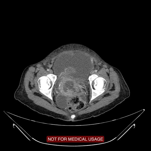 File:Adenocarcinoma of the cervix (Radiopaedia 28373-28616 Axial C+ portal venous phase 22).jpg