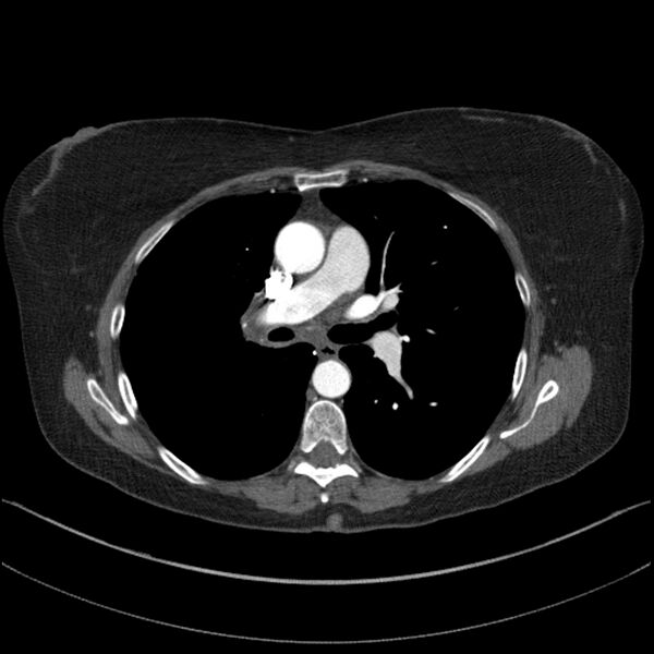 File:Adenocarcinoma of the lung (Radiopaedia 44205-47803 Axial C+ portal venous phase 39).jpg