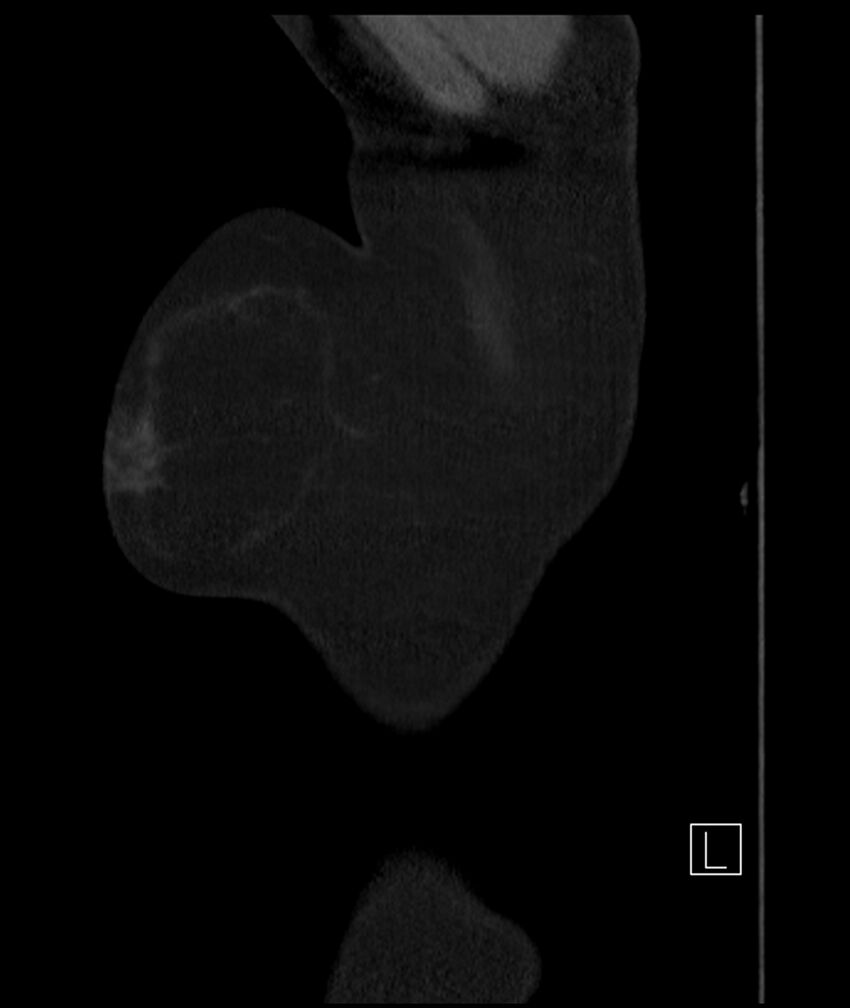 Adenocarcinoma of the lung (Radiopaedia 44205-47803 Sagittal C+ portal venous phase 59).jpg