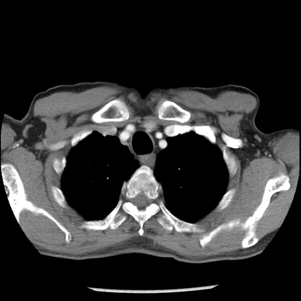 File:Adenocarcinoma of the lung - micropapillary predominant (Radiopaedia 42446-45563 Axial C+ portal venous phase 10).jpg