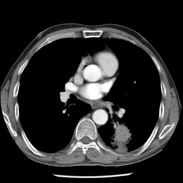 File:Adenocarcinoma of the lung - micropapillary predominant (Radiopaedia 42446-45563 Axial C+ portal venous phase 38).jpg