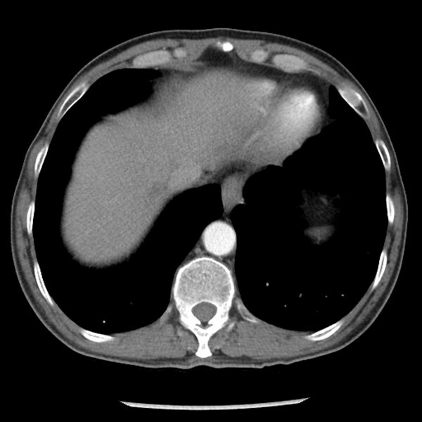 File:Adenocarcinoma of the lung - micropapillary predominant (Radiopaedia 42446-45563 Axial C+ portal venous phase 61).jpg