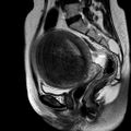 Adenomyoma of the uterus (huge) (Radiopaedia 9870-10438 Sagittal T2 11).jpg