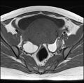 Adenomyosis - ovarian endometriomas (Radiopaedia 67031-76350 Axial T1 13).jpg