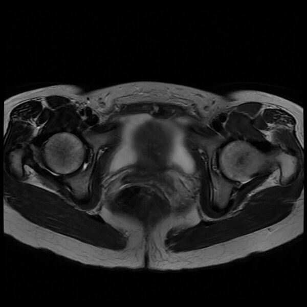 File:Adenomyosis on MRI (Radiopaedia 29328-29780 Axial T2 10).jpg