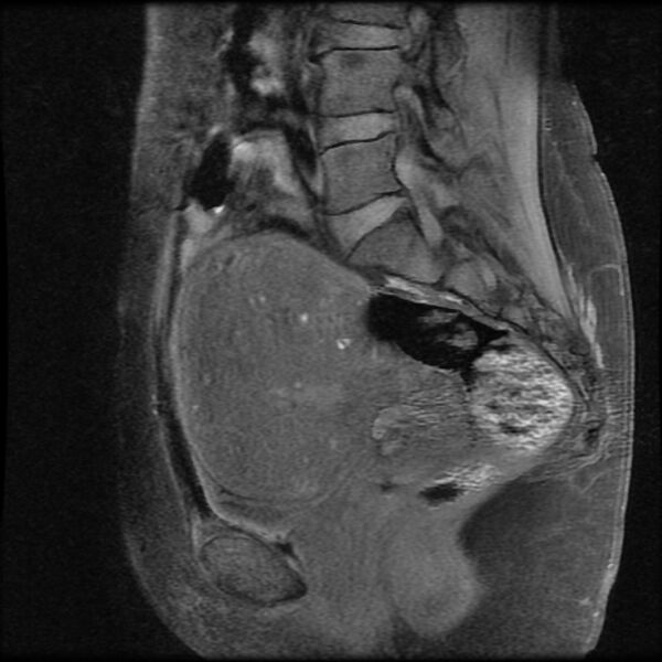 File:Adenomyosis on MRI (Radiopaedia 29328-29780 Sagittal T1 fat sat 10).jpg