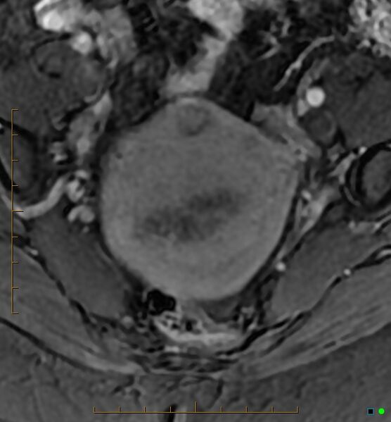File:Adenomyosis uterus with hematometra (Radiopaedia 45779-50011 Axial T1 C+ fat sat 14).jpg