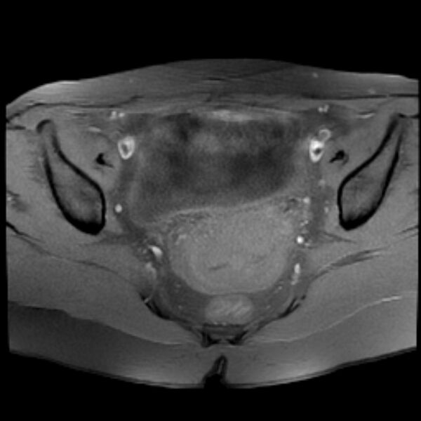 File:Adenomyosis within a septate uterus (Radiopaedia 69963-79981 Axial T1 fat sat 16).jpg