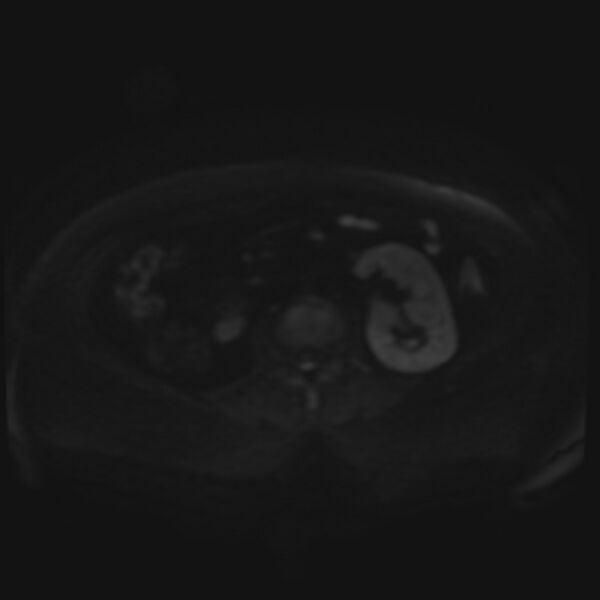 File:Adrenal cortical carcinoma (Radiopaedia 70906-81116 Axial DWI 50).jpg