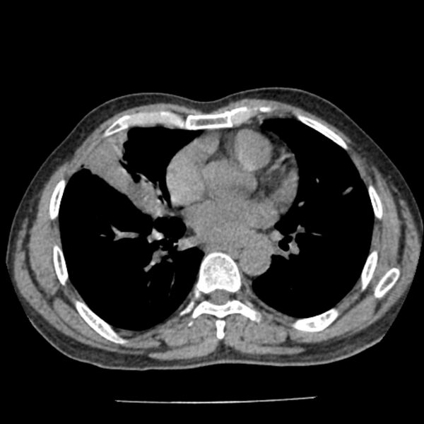 File:Airway foreign body in adult (Radiopaedia 85907-101779 Axial liver window 106).jpg