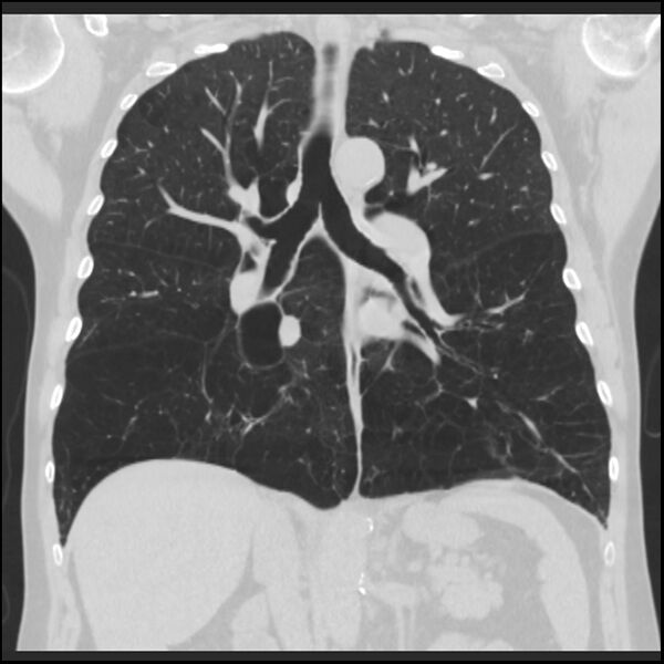 File:Alpha-1-antitrypsin deficiency (Radiopaedia 40993-43722 Coronal lung window 56).jpg