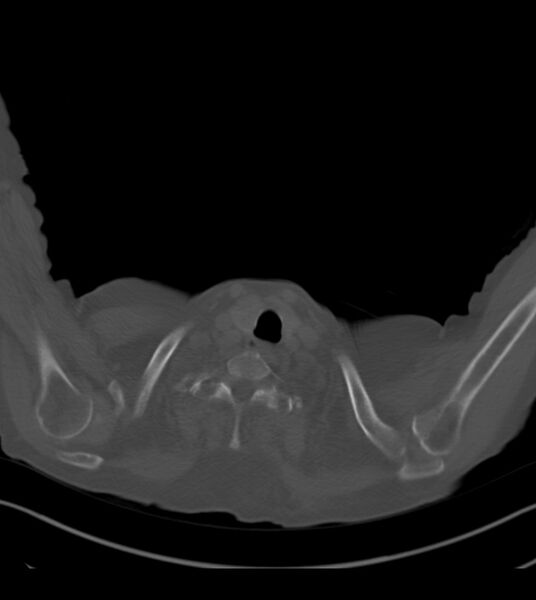 File:Amiodarone deposition in the liver (Radiopaedia 77587-89780 Axial bone window 2).jpg