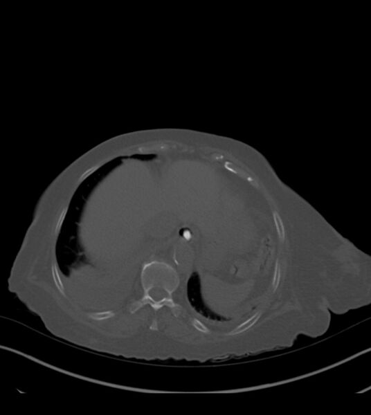 File:Amiodarone deposition in the liver (Radiopaedia 77587-89780 Axial bone window 68).jpg