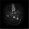 Amnestic syndrome secondary to hypoxic brain injury (Radiopaedia 24743-25004 DWI 4).jpg