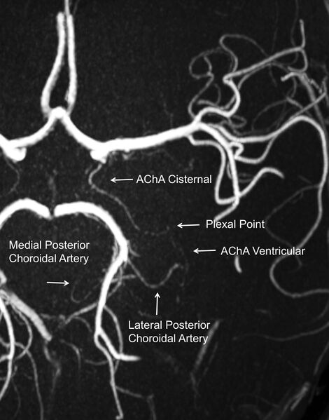 File:Anatomy of the anterior and posterior choroidal arteries (Radiopaedia 45629).jpg